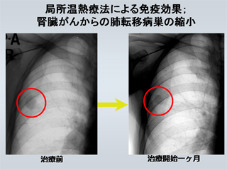 局所温熱療法による免疫効果