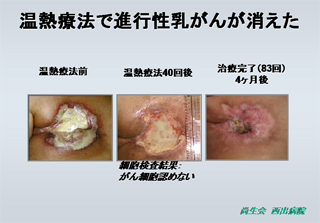温熱療法で進行乳がんが消えた