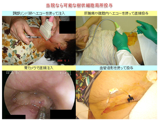 当院なら可能な樹状細胞局所投与